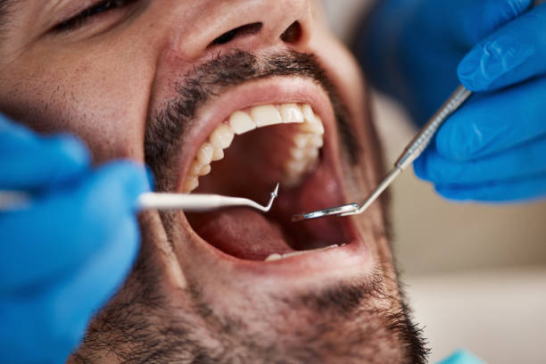 Best Emergency Wisdom Tooth Extraction in Nahunta, GA